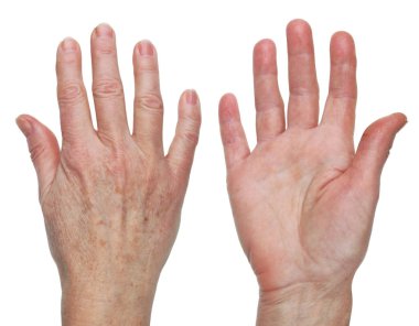 Kuru cilt bir yaşlı kadın anneanne elde acıyor. Beyaz stüdyo sette izole