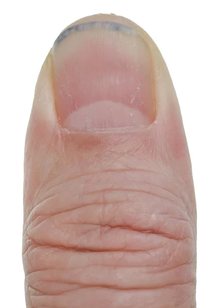 O polegar esquerdo do velho agricultor com uma unha partida suja macro isolada — Fotografia de Stock