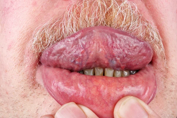 Пожилой человек с жёлтыми зубами показывает врачу внутренности — стоковое фото