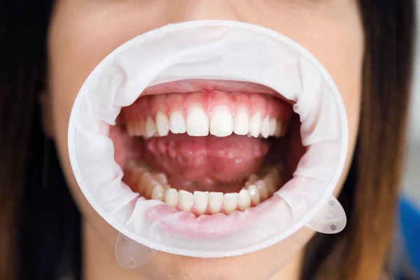 歯科オフィスの口頭試験を待っている口リトラクターを着た若い女性のクローズ アップ — ストック写真