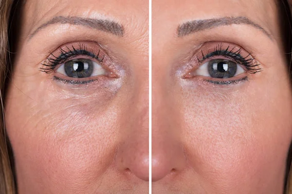 Photo Aging Procedures Caucasian Woman Face — Stock Photo, Image