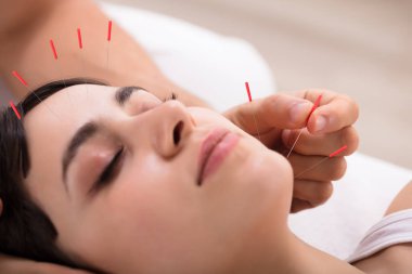 Güzel genç kadın güzellik Spa akupunktur tedavi görüyor