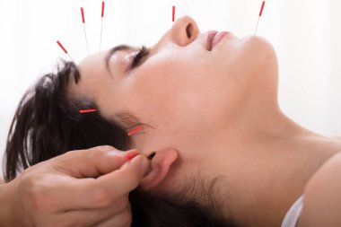 Akupunktur tedavisi kadın üzerinde performans bir terapistin el Close-up