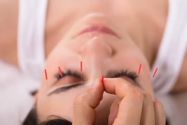 Mooie Jonge Vrouw Acupunctuur Behandeling Krijgen Beauty Spa — Stockfoto