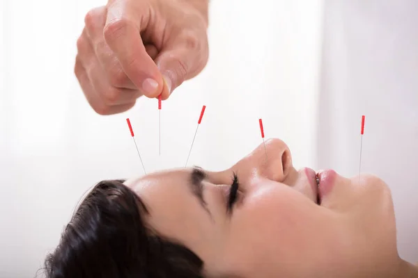 Beautiful Young Woman Getting Acupuncture Treatment Beauty Spa — Stock Photo, Image