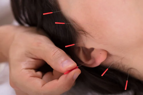 Close Therapist Hand Performing Acupuncture Treatment Woman — Stock Photo, Image