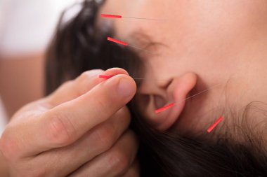 Akupunktur tedavisi kadın üzerinde performans bir terapistin el Close-up