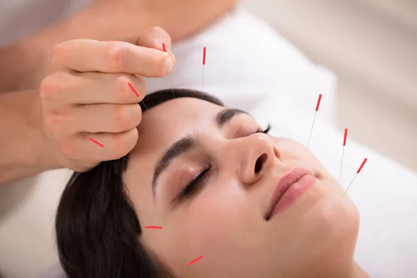 Mooie Jonge Vrouw Acupunctuur Behandeling Krijgen Beauty Spa — Stockfoto