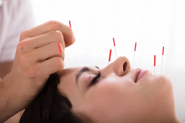 Beautiful Young Woman Getting Acupuncture Treatment Beauty Spa — Stock Photo, Image