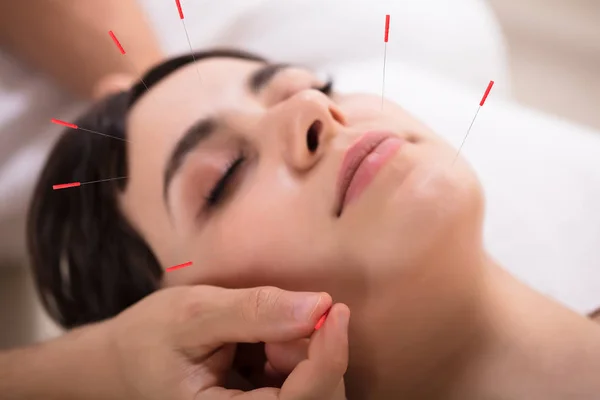 Vacker Ung Kvinna Att Akupunkturbehandling Beauty Spa — Stockfoto