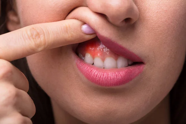 Close Woman Finger Showing Swelling Her Gum — Stock Photo, Image