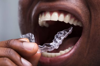 Yakın çekim bir adamın beyaz dişlerini şeffaf Aligners ayarlama