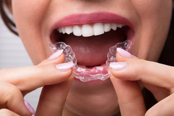 Close Mão Uma Mulher Colocando Alinhador Transparente Nos Dentes — Fotografia de Stock