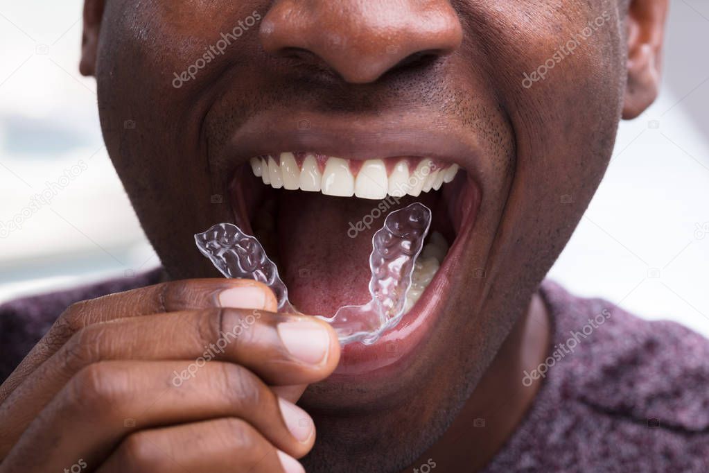 Close-up Of A Man Adjusting Transparent Aligners In His White Teeth