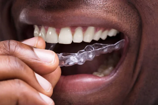 Zbliżenie Człowiek Regulacja Przezroczyste Korekcyjnych Jego Białe Zęby — Zdjęcie stockowe