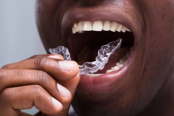 치아에 Aligners 남자의 클로즈업 — 스톡 사진