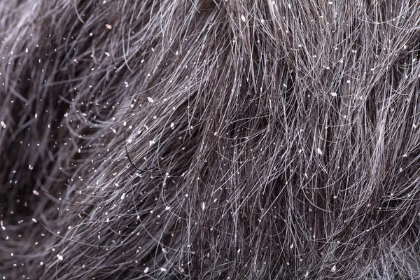 Full Frame Shot Of A Man\'s Hair With Dandruff