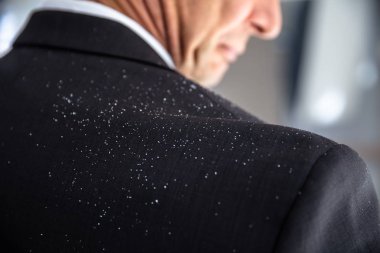 Close-up Of A Businessperson With Dandruff On His Shoulder clipart