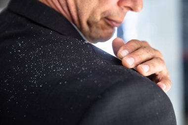 Bir işadamı elini omzuna düşmüş kepek kapalı fırçalama Close-up