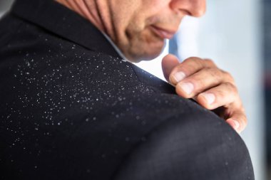 Close-up Of A Businessman's Hand Brushing Off Fallen Dandruff On Shoulder clipart
