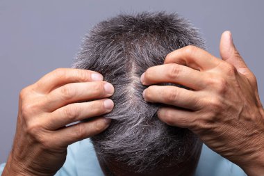 Mature Man With Dandruff Scratching His Head clipart