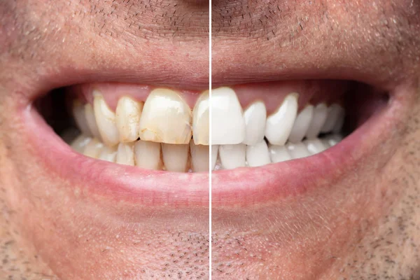 Primer Plano Hombre Sonriente Dientes Antes Después Blanquear — Foto de Stock