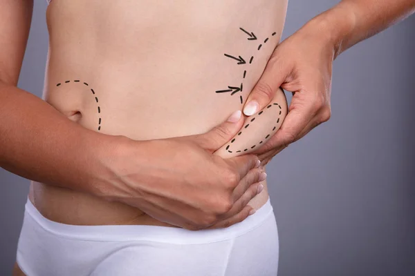 Mulher Beliscando Gordura Excessiva Estômago Com Linhas Correção — Fotografia de Stock