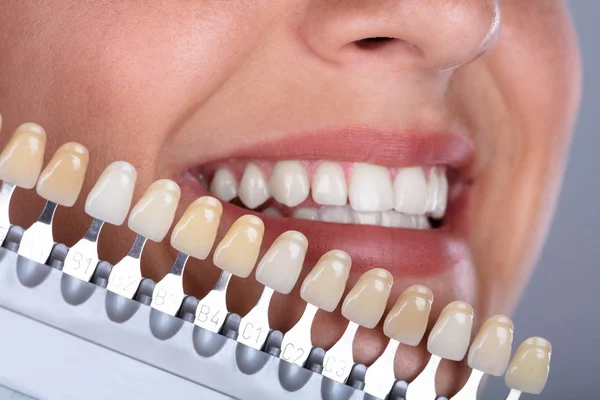 一个快乐的女人的特写与植入牙齿的阴影匹配 — 图库照片