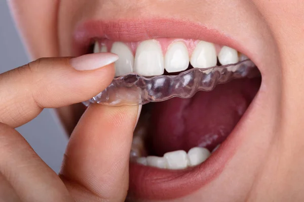 Close Woman Hand Putting Transparent Aligner Teeth — Stock Photo, Image