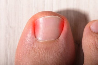 High Angle View Of Sore Toe Nail On Floor clipart