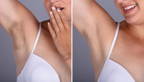 Före Och Efter Begreppet Kvinnans Underarm Hårborttagning Grå Bakgrund — Stockfoto