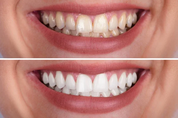 Primer Plano Los Dientes Una Mujer Sonriente Antes Después Del — Foto de Stock