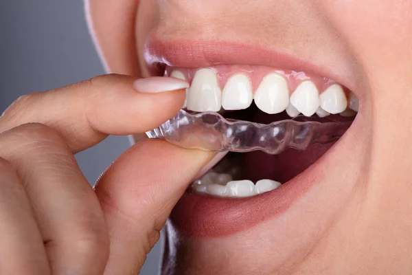 Close Mão Uma Mulher Colocando Alinhador Transparente Nos Dentes — Fotografia de Stock
