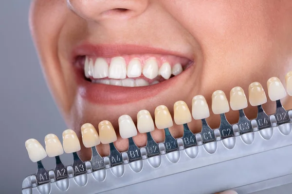 Gros Plan Une Femme Heureuse Assortie Ombre Des Dents Implant — Photo