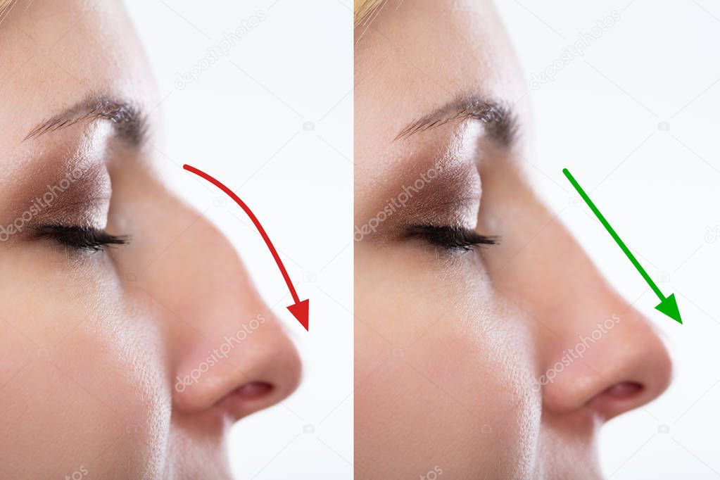 Woman's Nose Before And After Plastic Surgery With Red And Green Arrows