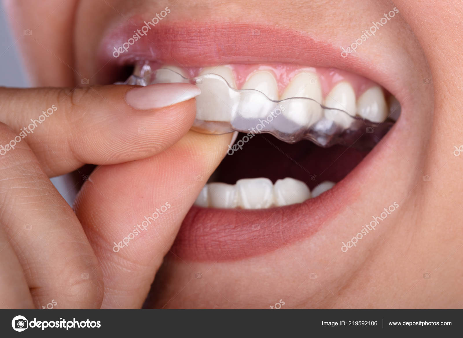 Primer Plano Mano Una Mujer Poniendo Alineador Transparente Los Dientes