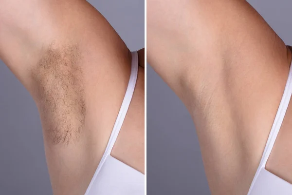 После Концепции Женского Подмышечного Удаления Волос Сером Фоне — стоковое фото