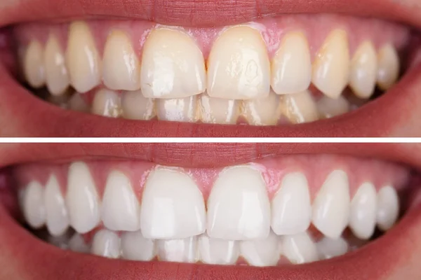 Gülümseyen Bir Kadının Diş Beyazlatma Sonra Önce Yakın Çekim — Stok fotoğraf