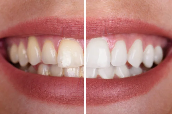 Close Dos Dentes Uma Mulher Sorridente Antes Depois Clareamento — Fotografia de Stock