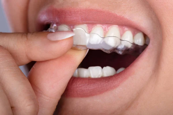 Zbliżenie Kobieta Ręka Wprowadzenie Przezroczysty Aligner Zęby — Zdjęcie stockowe
