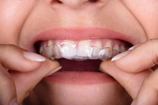 Zbliżenie Kobieta Ręka Wprowadzenie Przezroczysty Aligner Zęby — Zdjęcie stockowe
