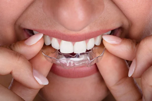 Close Mão Uma Mulher Colocando Alinhador Transparente Nos Dentes — Fotografia de Stock