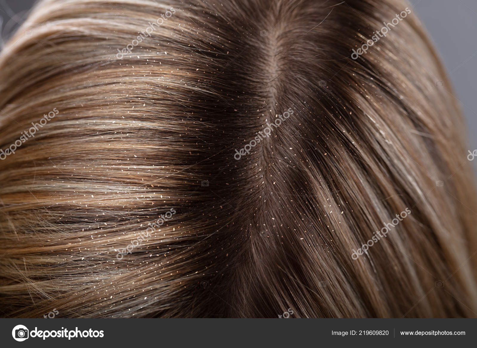Pictures Blonde Hair With Highlights Close Dandruff Woman