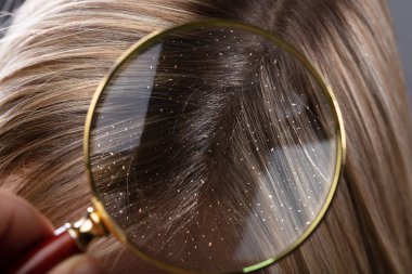 Close-up Of A Dandruff In Blonde Hair Seen Through Magnifying Glass clipart