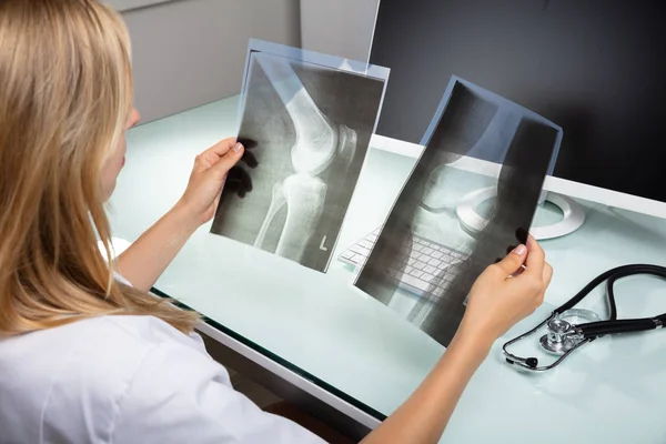 Primo Piano Medico Femminile Che Esamina Raggi Del Ginocchio Clinica — Foto Stock