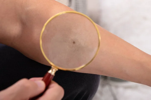 Primer Plano Hombre Examinando Lunar Mano Con Lupa — Foto de Stock