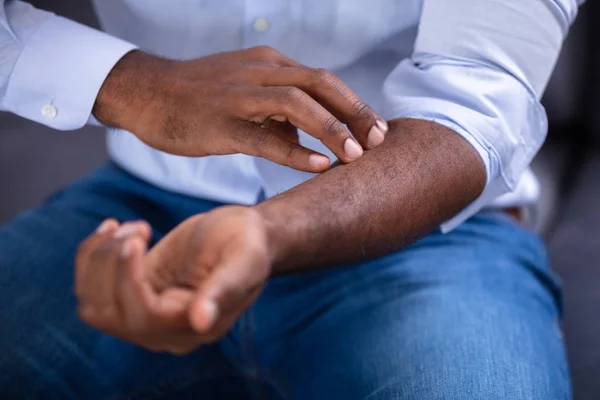 Close African Man Scratching His Hand — Stock Photo, Image