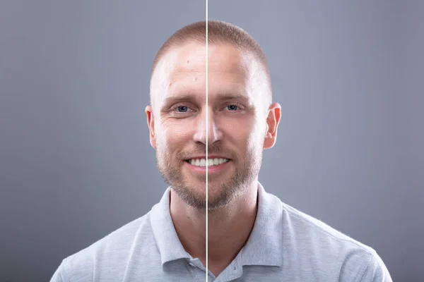 Portrait Of A Smiling Man's Face Before And After Cosmetic Procedure On Grey Background