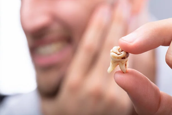 Close Man Hand Holding Decayed Tooth — Stock Photo, Image