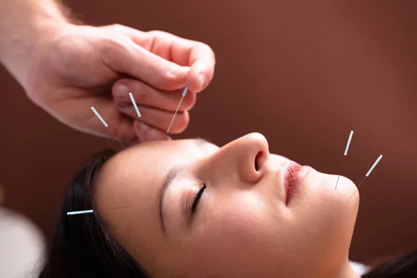 Close Woman Face Receiving Acupuncture Treatment Her Face Spa — Stock Photo, Image